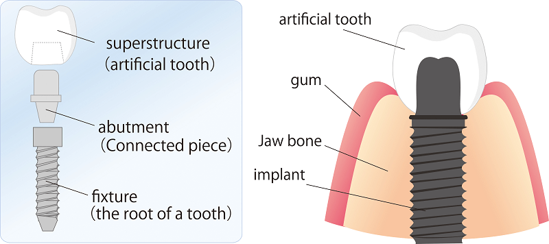 dental implant illustration